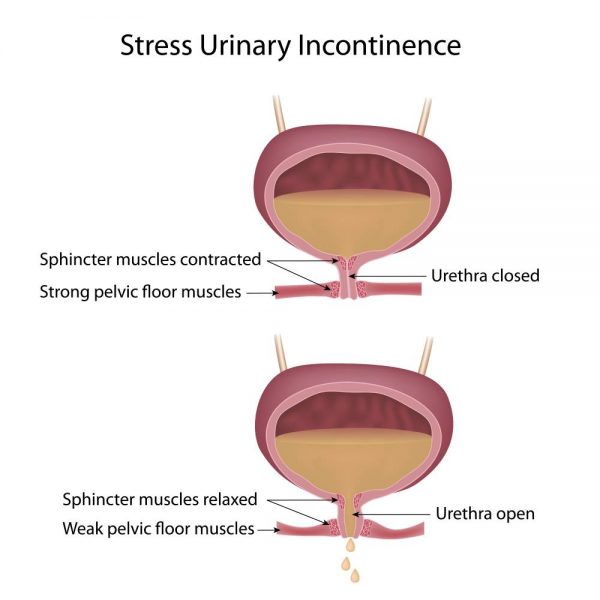 pelvicfloorstressincontinence Incontinence UK