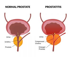 Prostatitis