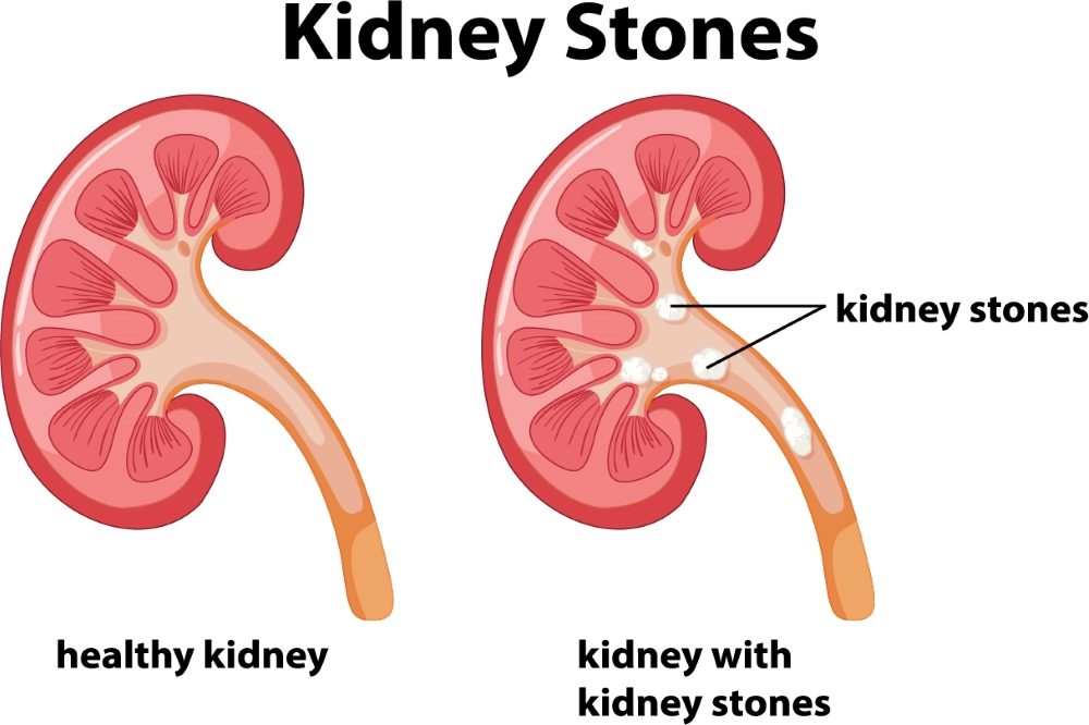 images of kidney stones in urine